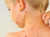 chicken-pox-in-adults-an-acute-disease-4_12742400