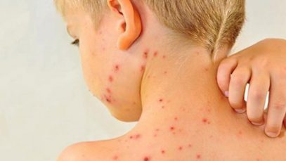 chicken-pox-in-adults-an-acute-disease-4_12742400