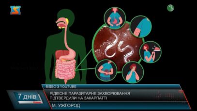 Рідкісне паразитарне захворювання підтвердили на Закарпатті